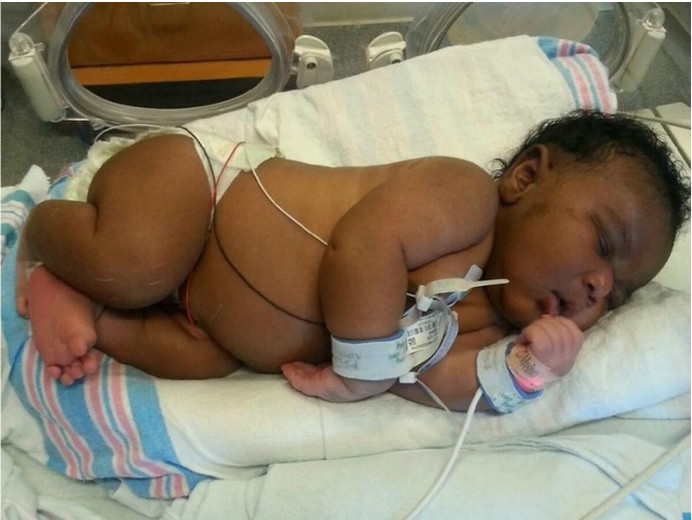 Mỹ: Em bé sơ sinh nặng gần 6,5kg