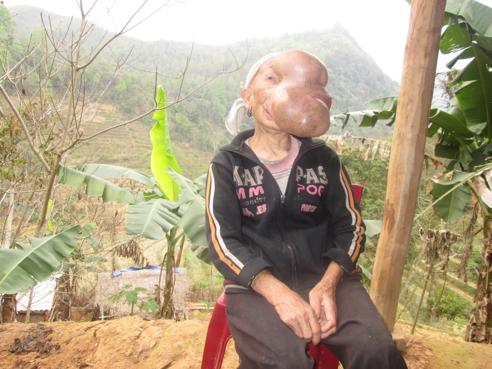 Tận cùng nỗi đau của người phụ nữ 25 năm mang khối u khổng lồ trên mặt
