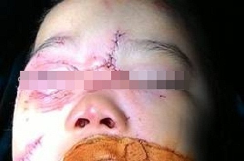 Hà Nội: Bé trai 3 tuổi bị chó nhà cắn rách giác mạc, vành tai