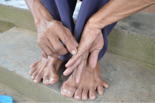 Người đàn ông có nhiều ngón tay, chân