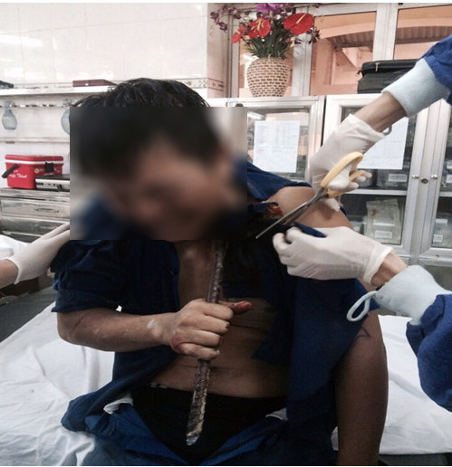 Tin tức xã hội ngày 28/10: Nam thanh niên bị thanh thép lớn đâm xuyên qua cổ