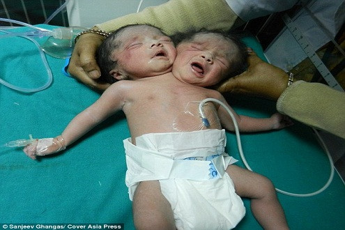 Kỳ lạ bé sơ sinh hai đầu ở Bangladesh