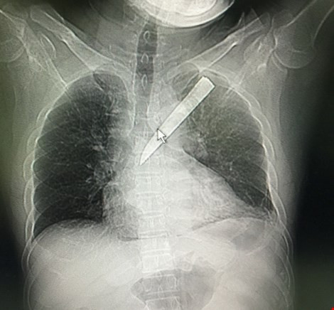 Tin tức xã hội ngày 4/1: Mang lưỡi dao gãy trong phổi đi cấp cứu