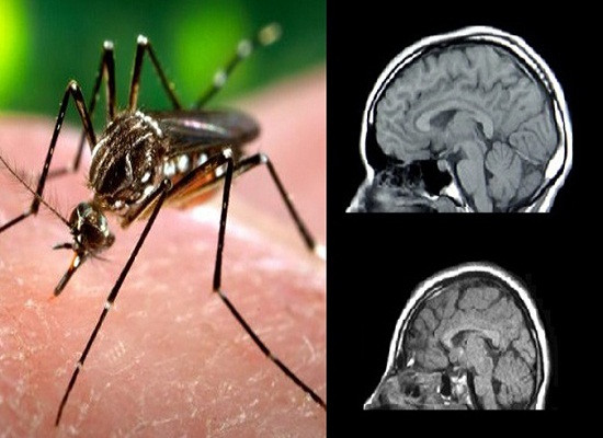Virus zika gây teo não tấn công Châu Âu