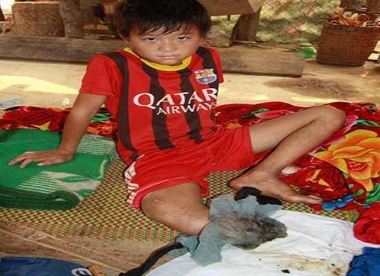 Cậu bé dân tộc Mông “xin cắt chân” đã được phẫu thuật thành công
