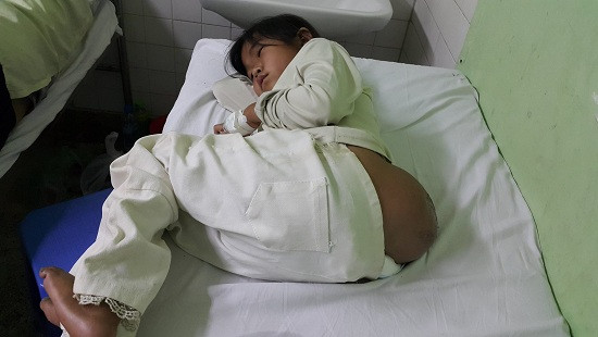 Xót thương bé gái người Mông cõng khối u 10kg suốt 10 năm
