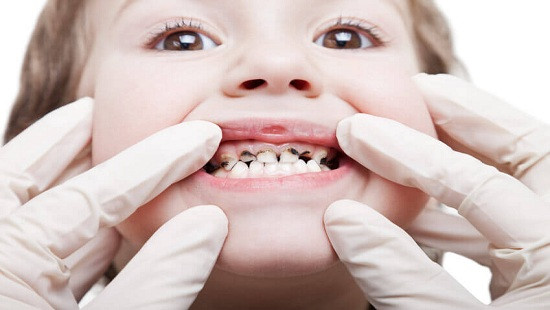 Những hiểu lầm nghiêm trọng về răng sữa của trẻ