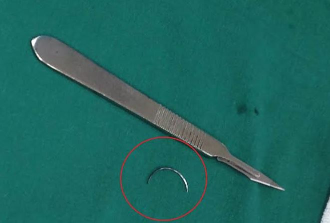 Phẫu thuật thành công cho bệnh nhân bị bỏ quên kim khâu trong bụng 15 năm
