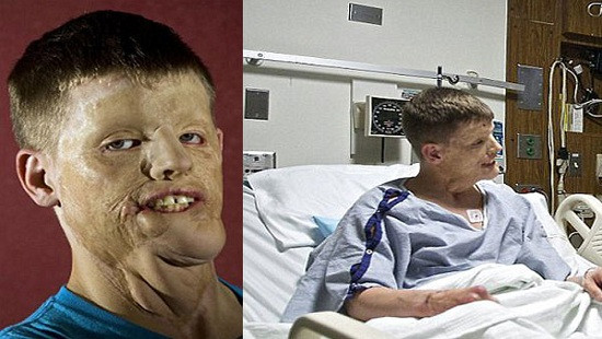 Câu chuyện cuộc đời của người đàn ông sau 5 năm phẫu thuật cấy ghép khuôn mặt