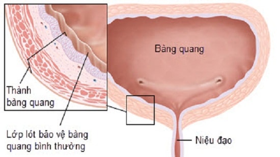 Nhịn tiểu làm giảm ham muốn tình dục 