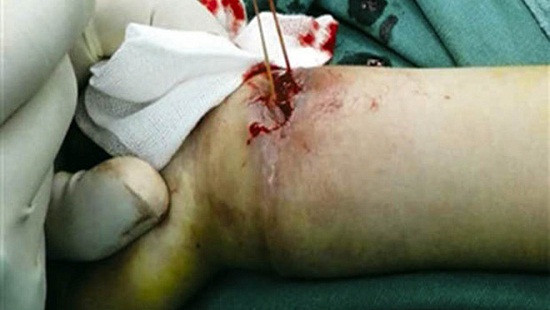 Tin tức 24h về sức khỏe: Cậu bé 4 tuổi suýt bị cắt tay vì một chiếc vòng chun