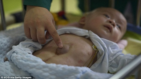 Tin tức 24h về sức khỏe: Em bé có tim ngoài cơ thể bị bỏ rơi ở Trung Quốc