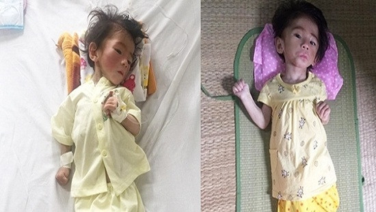 Bé gái 14 tháng tuổi suy dinh dưỡng nặng vì đói ăn đã tăng cân và được xuất viện