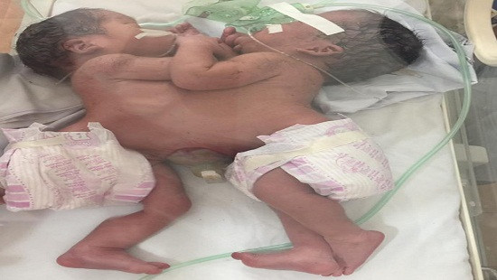 Bộ Y tế kêu gọi cộng đồng giúp đỡ gia đình hai bé sơ sinh dính liền