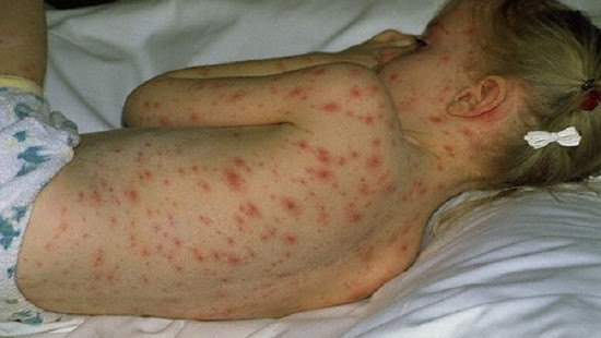 Bộ Y tế lý giải vì sao số ca sốt xuất huyết tăng chóng mặt 