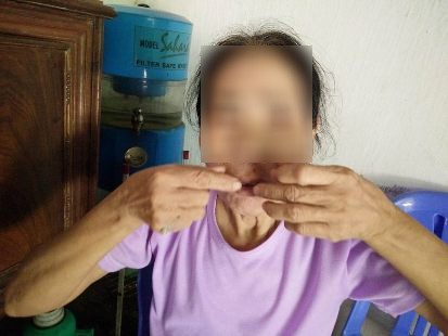 Vụ nổ súng ở Thanh Hóa: Đang ăn cơm bị đạn sượt qua môi