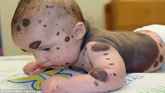 Căn bệnh quái ác khiến bé trai sinh ra với làn da phủ kín nốt ruồi