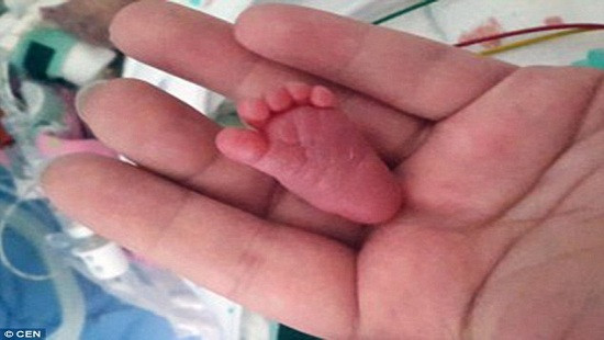 Sức sống kỳ diệu của bé sơ sinh nhỏ nhất thế giới 