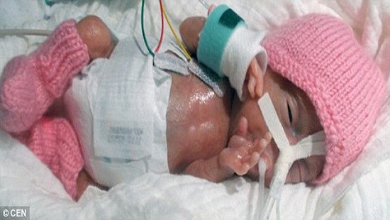 Sức sống kỳ diệu của bé sơ sinh nhỏ nhất thế giới 