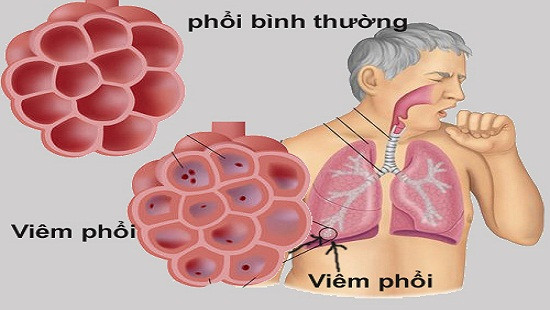Bệnh viêm phổi có triệu chứng như thế nào?