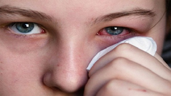 Đề phòng bệnh đau mắt đỏ bùng phát thành dịch 