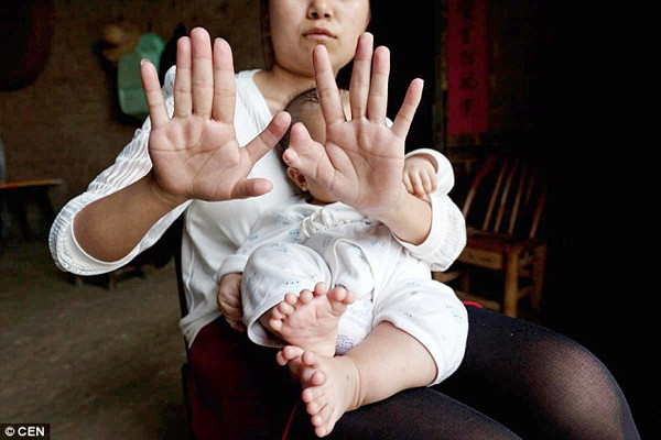 Tiến hành phẫu thuật cho em bé có 31 ngón tay và chân