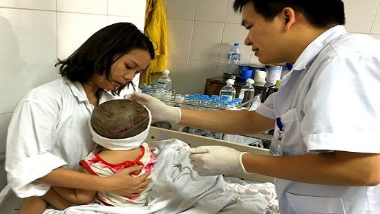 Ghép da đầu cho bệnh nhi nhỏ tuổi nhất tại Việt Nam 