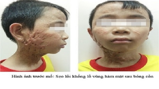 Phẫu thuật điều trị sẹo lồi khổng lồ vùng hàm mặt sau bỏng cồn cho bé trai 9 tuổi