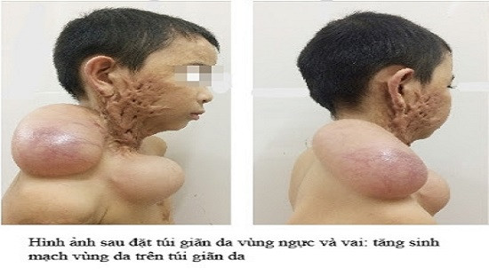 Phẫu thuật điều trị sẹo lồi khổng lồ vùng hàm mặt sau bỏng cồn cho bé trai 9 tuổi