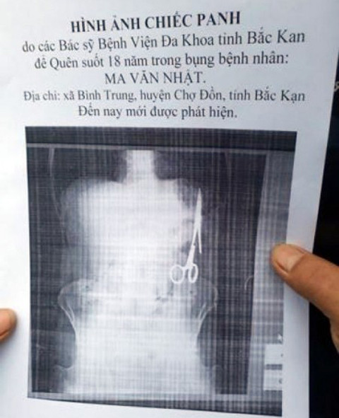 Bắc Kạn: Mổ lấy chiếc kéo để quên 18 năm trong bụng bệnh nhân