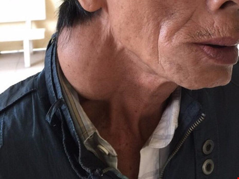 Khánh Hòa: Mổ thành công khối u hơn 20 năm trên cổ người đàn ông 65 tuổi