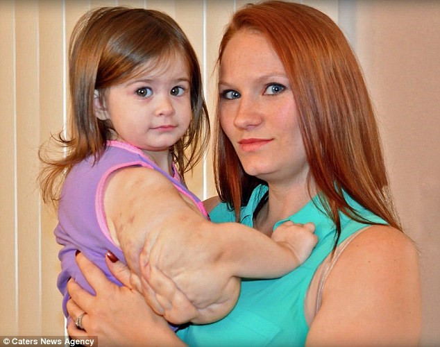 Bé gái 2 tuổi sống sót kì diệu với khối u nặng 2kg