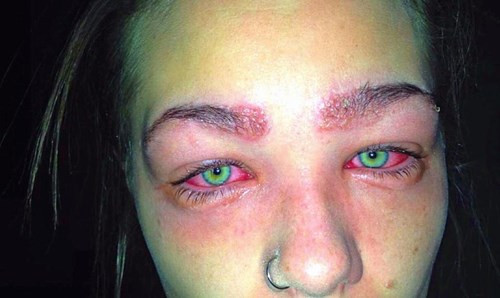 Cô gái 16 tuổi suýt mù mắt vì nhuộm lông mày