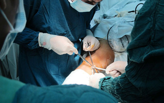 Phẫu thuật thay khớp gối bệnh nhân hoại tử vô mạch lồi cầu đùi hiếm gặp