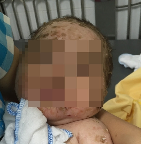 Bé trai 4 tháng tuổi nhiễm độc da toàn thân do mẹ tắm lá chữa thủy đậu