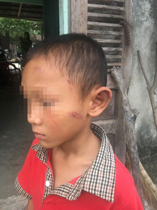 Quảng Ngãi: Bé trai 5 tuổi bị dì ruột bạo hành