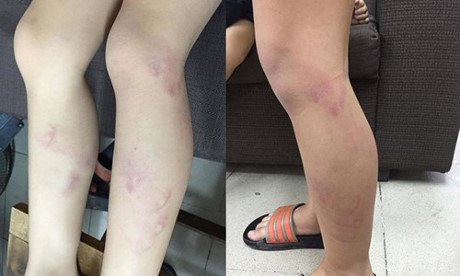 Hà Nội: Tạm đình chỉ cô giáo đánh trẻ lớp 2 tím chân