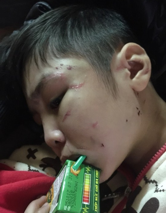 Chi chít vết thương trên khuôn mặt bé trai bị cha ruột hành hạ