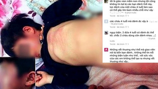 Phụ huynh nói gì về những vết bầm tím của bé gái 4 tuổi ở Bắc Giang?