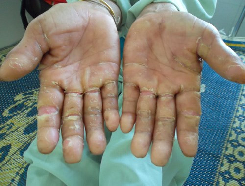 Quảng Ngãi: Hội chứng viêm da dày sừng tái phát sau 3 năm tạm lắng
