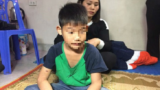 Bé trai bị bạo hành ở Đông Anh: Bố mẹ ký đơn hòa giải
