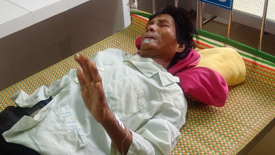Thêm bệnh nhân mắc bệnh viêm da dày sừng ở Quảng Ngãi