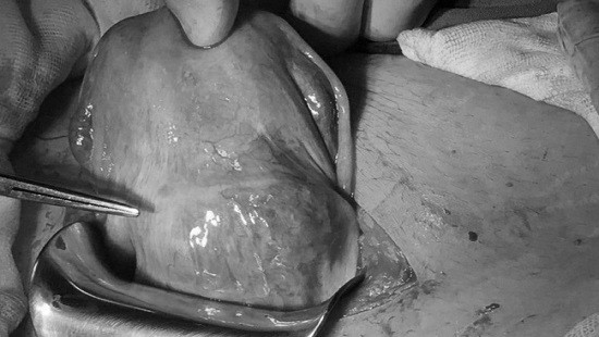 Thai bám sẹo mổ cũ, thai phụ bị rong huyết bất thường