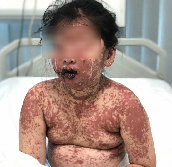 Dị ứng thuốc, bé 7 tuổi bị bỏng toàn thân