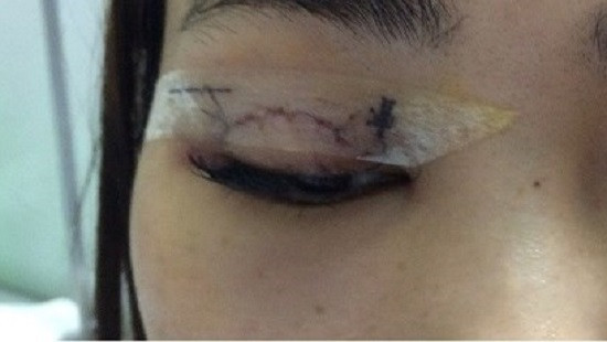 Tá hóa phát hiện kim 'chui' vào mắt sau khi nhấn mí