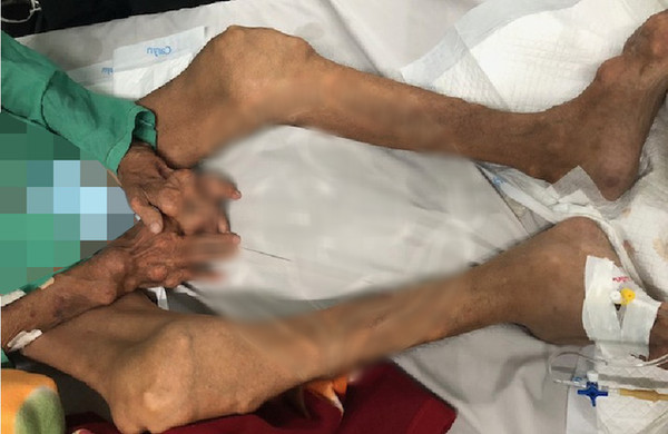 10 năm tự trị bệnh gout, người đàn ông bị biến dạng tay chân