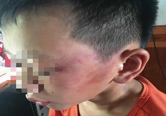 Nghi vấn cô giáo ở Nghệ An đánh con riêng của chồng phải nhập viện