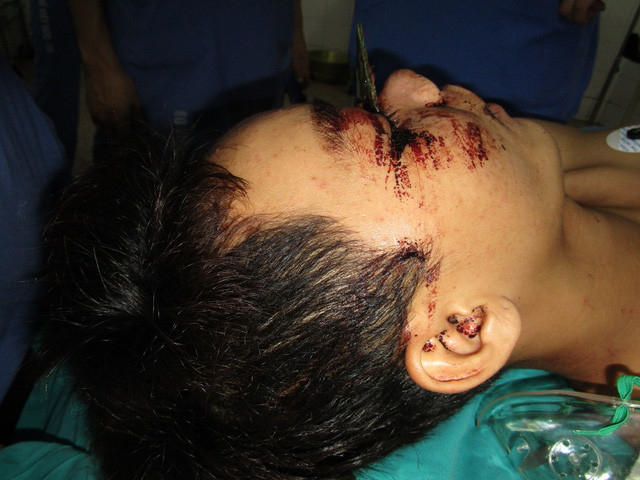 Phẫu thuật thành công cho nam thanh niên bị lưỡi cưa sắt găm ngang mặt