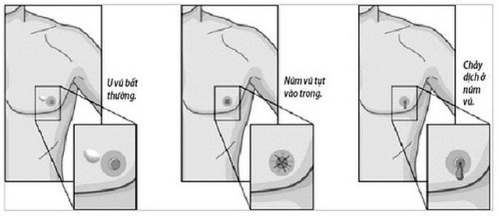 Dấu hiệu nhận biết ung thư vú ở nam giới