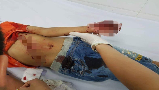 Nghệ An: Đồ chơi chạy bằng pin phát nổ, bé 8 tuổi nhập viện cấp cứu